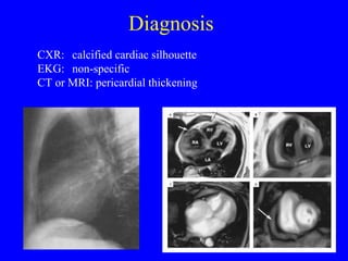 Diagnosis
CXR: calcified cardiac silhouette
EKG: non-specific
CT or MRI: pericardial thickening
 
