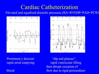 Cardiac Catheterization
Prominent y descent: “dip and plateau”:
rapid atrial emptying rapid ventricular filling
then abrupt cessation of
blood flow due to rigid pericardium
Elevated and equalized diastolic pressures (RA=RVEDP=PAD=PCW)
 