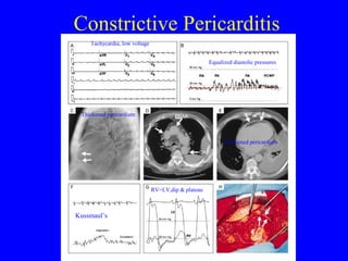 Constrictive Pericarditis
Kussmaul’s
RV=LV,dip & plateau
Equalized diastolic pressures
Tachycardia, low voltage
Thickened pericardium
Thickened pericardium
 