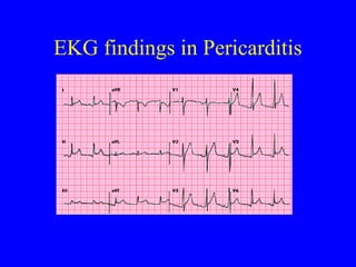 EKG findings in Pericarditis
 