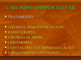 CARCINOMA ESPINOCELULARCARCINOMA ESPINOCELULAR
 TRATAMENTO:TRATAMENTO:
 CIRURGIA: MARGEM DE 0,5-1CM;CIRURGIA: MARGEM DE 0,5-1CM;
 RADIOTERAPIA;RADIOTERAPIA;
 CIRURGIA DE MOHS;CIRURGIA DE MOHS;
 CRIOTERAPIA;CRIOTERAPIA;
 CURETAGEM E ELETROCOAGULAÇÃO;CURETAGEM E ELETROCOAGULAÇÃO;
 ESVAZIAMENTO LINFONODAL;ESVAZIAMENTO LINFONODAL;
 