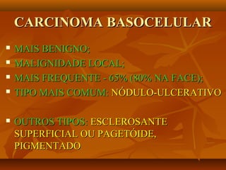 CARCINOMA BASOCELULARCARCINOMA BASOCELULAR
 MAIS BENIGNO;MAIS BENIGNO;
 MALIGNIDADE LOCAL;MALIGNIDADE LOCAL;
 MAIS FREQUENTE - 65% (80% NA FACE);MAIS FREQUENTE - 65% (80% NA FACE);
 TIPO MAIS COMUM:TIPO MAIS COMUM: NÓDULO-ULCERATIVONÓDULO-ULCERATIVO
 OUTROS TIPOS:OUTROS TIPOS: ESCLEROSANTEESCLEROSANTE
SUPERFICIAL OU PAGETÓIDE,SUPERFICIAL OU PAGETÓIDE,
PIGMENTADOPIGMENTADO
 