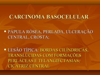 CARCINOMA BASOCELULARCARCINOMA BASOCELULAR
 PÁPULA RÓSEA, PERLADA, ULCERAÇÃOPÁPULA RÓSEA, PERLADA, ULCERAÇÃO
CENTRAL, CROSTA;CENTRAL, CROSTA;
 LESÃO TÍPICALESÃO TÍPICA: BORDAS CILÍNDRICAS,: BORDAS CILÍNDRICAS,
TRANSLÚCIDAS COM FORMAÇÕESTRANSLÚCIDAS COM FORMAÇÕES
PERLÁCEAS E TELANGIECTASIAS;PERLÁCEAS E TELANGIECTASIAS;
CICATRIZ CENTRALCICATRIZ CENTRAL
 
