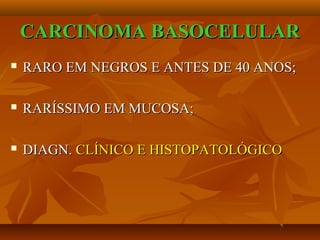 CARCINOMA BASOCELULARCARCINOMA BASOCELULAR
 RARO EM NEGROS E ANTES DE 40 ANOS;RARO EM NEGROS E ANTES DE 40 ANOS;
 RARÍSSIMO EM MUCOSA;RARÍSSIMO EM MUCOSA;
 DIAGN.DIAGN. CLÍNICO E HISTOPATOLÓGICOCLÍNICO E HISTOPATOLÓGICO
 