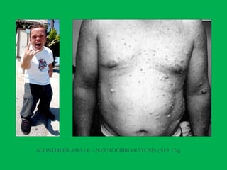 ACONDROPLASIA (4) – NEUROFIBROMATOSIS (NF1 17q)
 