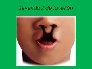 Severidad de la lesión
 
