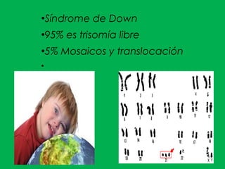 ●
Síndrome de Down
●
95% es trisomía libre
●
5% Mosaicos y translocación
●
 