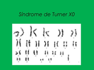 Síndrome de Turner X0
 