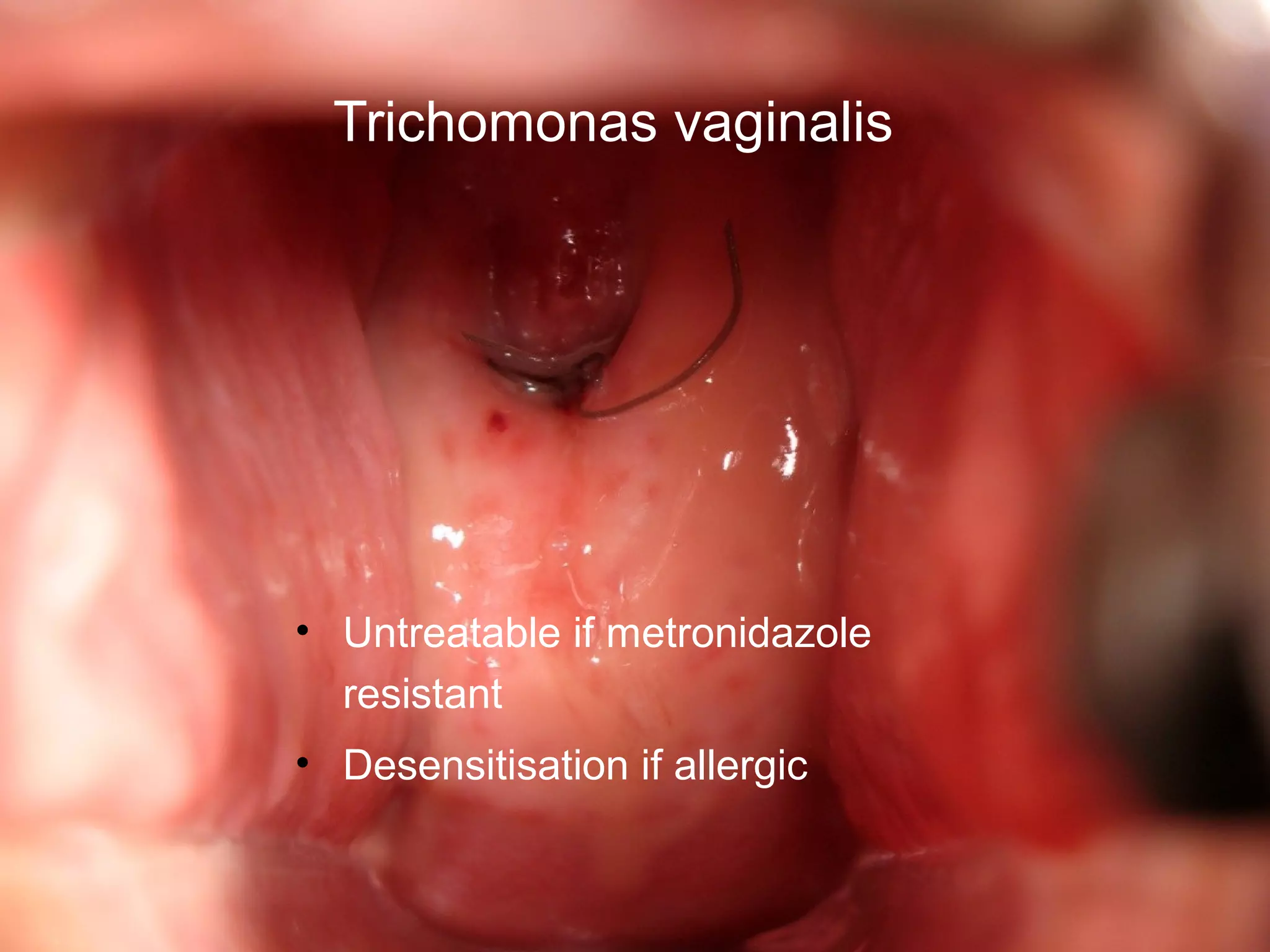 Trichomonas vaginalis
• Untreatable if metronidazole
resistant
• Desensitisation if allergic
 