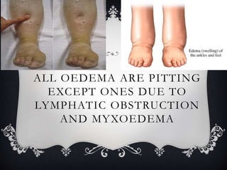 ALL OEDEMA ARE PITTING
EXCEPT ONES DUE TO
LYMPHATIC OBSTRUCTION
AND MYXOEDEMA
 