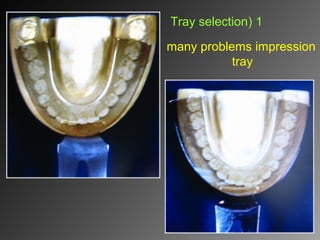 many problems impression
tray
1(Tray selection
 