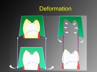 Deformation
 