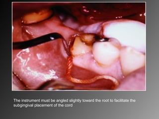 The instrument must be angled slightly toward the root to facilitate the
subgingival placement of the cord
 