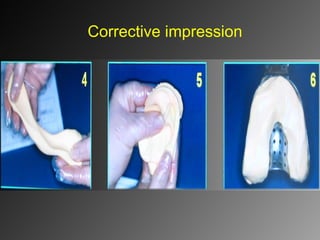Corrective impression
 