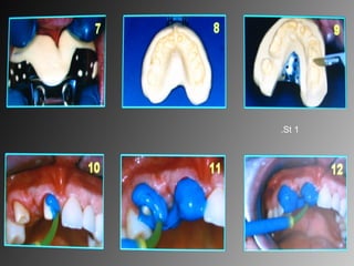 Corrective impression
1St.
 