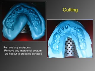 Cutting
Remove any undercuts
Remove any interdental septum
Do not cut to prepared surfaces
 