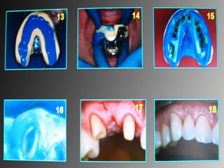 Corrective impression
 