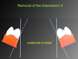 undercuts in lower
4(Removal of the impression
 