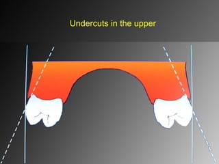 Undercuts in the upper
 