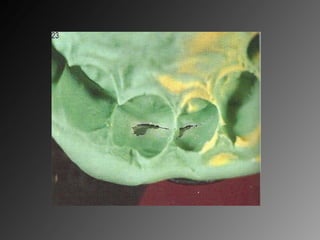 7.impression materials and techniques 2