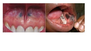 oral pigmented lesions