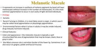 orlistat l carnitina similares Melanocytic Lesions | A Guide to Clinical Differential Diagnosis of Oral  Mucosal Lesions | Continuing Education Course main image 1