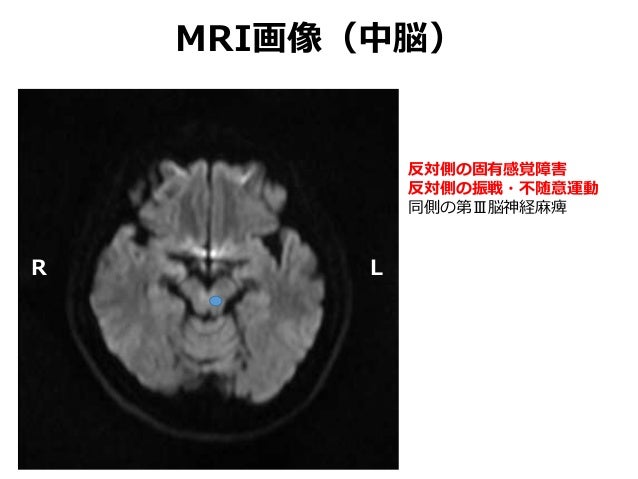 画像からみた運動障害