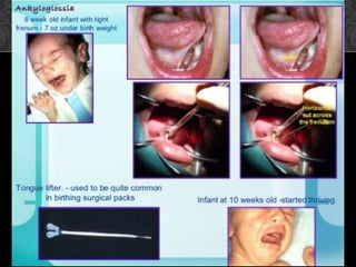 Surgical Procedures in Pediatric Dentistry: Enhancing Oral Health