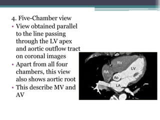 4. Five-Chamber view
• View obtained parallel
to the line passing
through the LV apex
and aortic outflow tract
on coronal images
• Apart from all four
chambers, this view
also shows aortic root
• This describe MV and
AV
 