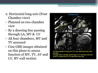 2. Horizontal long-axis (Four
Chamber view)
• Planned on two chamber
view
• By a drawing line passing
through LA, MV & LV
• All four chambers, MV and
TV assessed
• Cine GRE images obtained
on this plane to assess
function of MV, TV, AV and
LV, RV wall motion
 