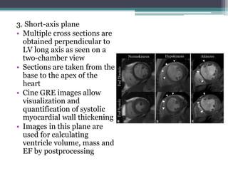 3. Short-axis plane
• Multiple cross sections are
obtained perpendicular to
LV long axis as seen on a
two-chamber view
• Sections are taken from the
base to the apex of the
heart
• Cine GRE images allow
visualization and
quantification of systolic
myocardial wall thickening
• Images in this plane are
used for calculating
ventricle volume, mass and
EF by postprocessing
 