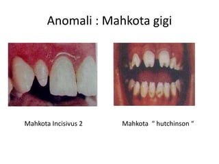 Anomali : Mahkota gigi
Mahkota Incisivus 2 Mahkota “ hutchinson “
 