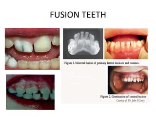 FUSION TEETH
 