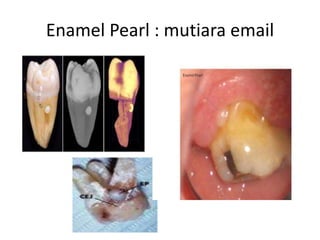 Enamel Pearl : mutiara email
 