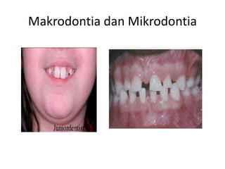 Makrodontia dan Mikrodontia
 