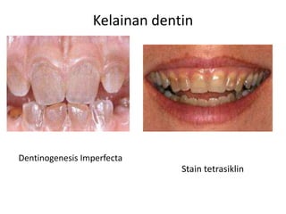 Kelainan dentin
Dentinogenesis Imperfecta
Stain tetrasiklin
 