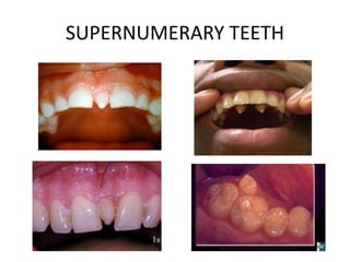 SUPERNUMERARY TEETH
 