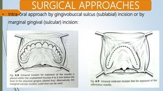 Sublabial Excision 7. fractures of middle third of facial skeleton | PPTX