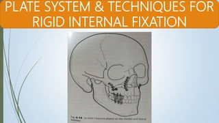 Semi Rigid Fixation Examples 7. fractures of middle third of facial skeleton | PPTX