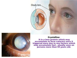 cataract case study slideshare