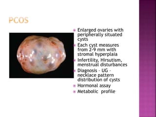  Enlarged ovaries with
peripherally situated
cysts
 Each cyst measures
from 2-9 mm with
stromal hyperplaia
 Infertility, Hirsutism,
menstrual disturbances
 Diagnosis – UG –
necklace pattern
distribution of cysts
 Hormonal assay
 Metabolic profile
 