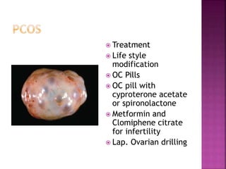  Treatment
 Life style
modification
 OC Pills
 OC pill with
cyproterone acetate
or spironolactone
 Metformin and
Clomiphene citrate
for infertility
 Lap. Ovarian drilling
 