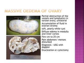  Partial obstruction of the
vessels and lymphatics in
torsion ovary, unilateral
 Accumulation of fluid in
ovarian stroma
 soft, pearly white cyst
 Diffuse edema in medulla
and inner cortex
 Few cm to 25 cm
 Pain abdomen/ menses
disturbed
 Diagnosis - USG with
doppler
 Enucleation or cytectomy
 