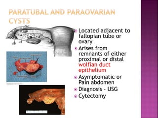  Located adjacent to
fallopian tube or
ovary
 Arises from
remnants of either
proximal or distal
wolfian duct
epithelium
 Asymptomatic or
Pain abdomen
 Diagnosis - USG
 Cytectomy
 