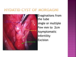  Evaginations from
the tube
 single or multiple
 Few mm to 2cm
 Asymptomatic
 Infertility
 Excision
 