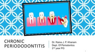 CHRONIC
PERIODODONTITIS
Dr. Raina J. P. Khanam
Dept. Of Periodontics
2nd year PG
1
 