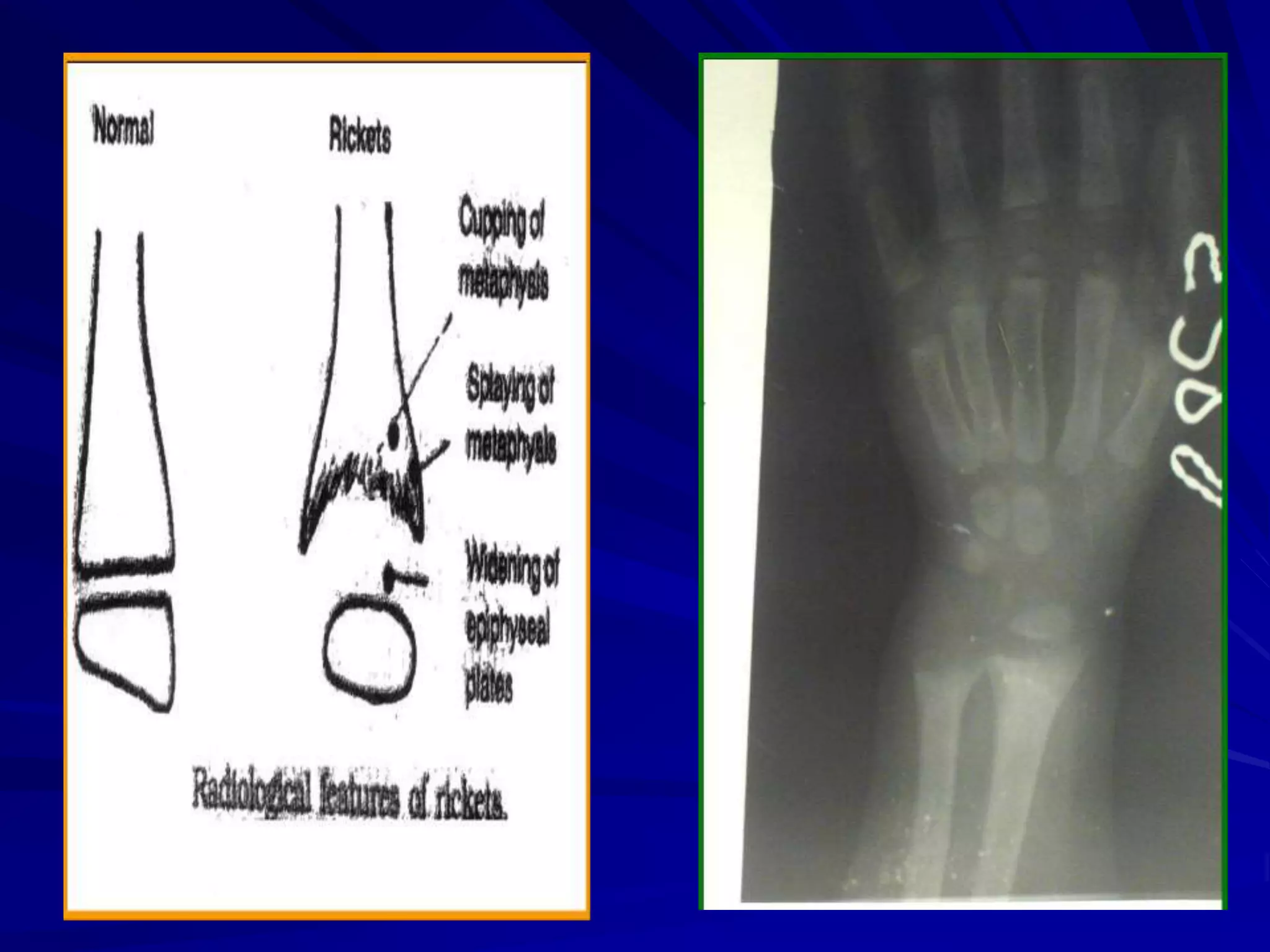 Rickets and osteomalacia | PPT