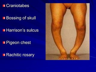 Rickets and osteomalacia | PPT