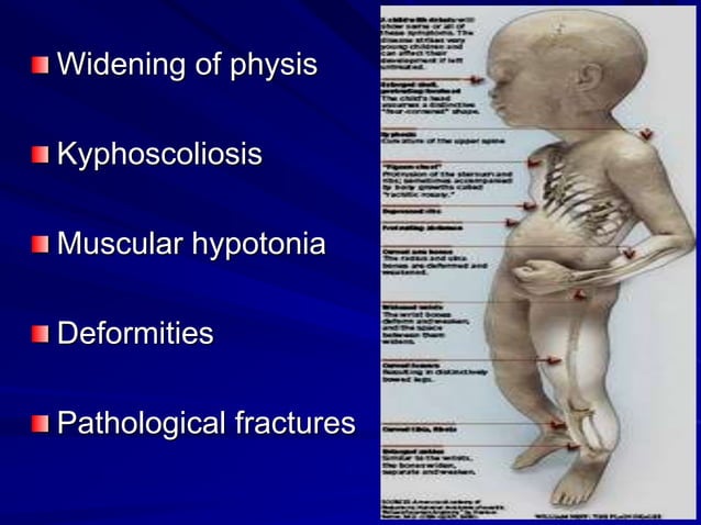 Rickets and osteomalacia | PPT