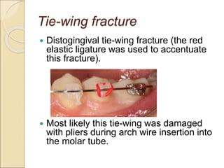 Tie-wing fracture
 Distogingival tie-wing fracture (the red
elastic ligature was used to accentuate
this fracture).
 Most likely this tie-wing was damaged
with pliers during arch wire insertion into
the molar tube.
 